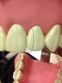 前歯隣接CR治療の大事な部分