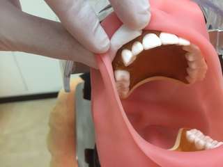 丸ワッテの真ん中が充填したい歯にくるように銀鏡移行部に入れる