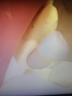 歯頚部CR充填の第一段階の口腔内写真
