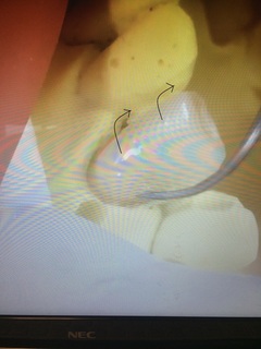 上の矢印：歯質の隅角、下の矢印：CRの隅角