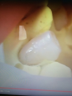 歯頸部CR充填完了