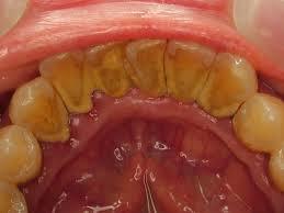 歯についた歯石