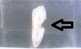 WSD歯の断面図