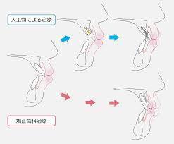 前歯の向きが変わる