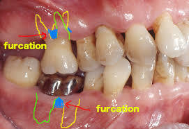 大臼歯は根っこが複数ある