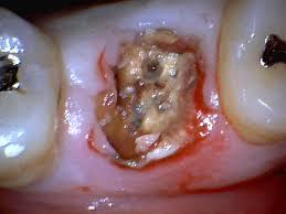 残根の歯
