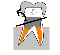 歯質より上部のメタルコアは全て除去する