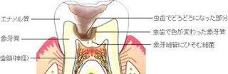 虫歯の断面図