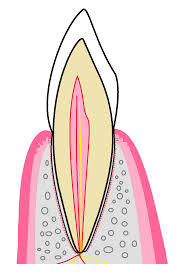 前歯横から断面図