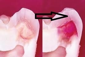 エナメル質部分の虫歯
