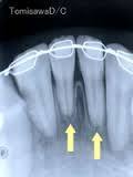 矯正治療に伴う歯根吸収