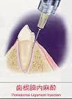 歯根膜注射