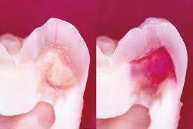 軟化象牙質の断面図